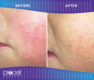 ProCell Face & Neck Microchanneling Treatment with LED Light Therapy