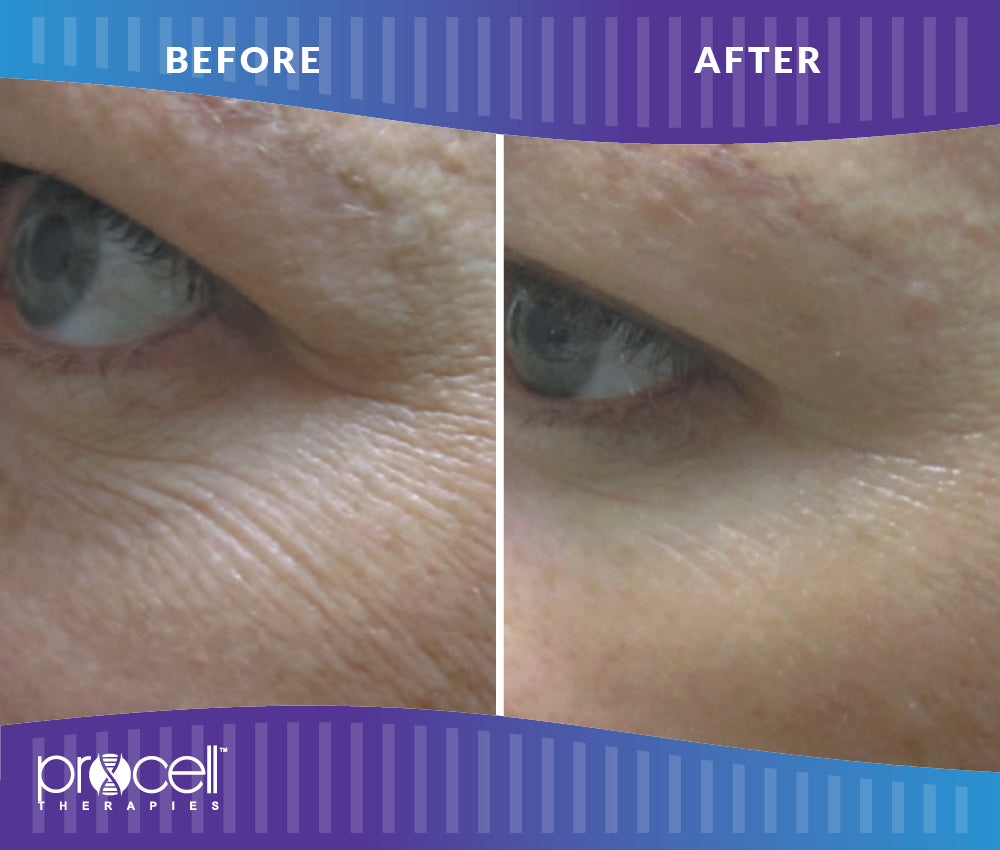 ProCell Face & Neck Microchanneling Treatment with LED Light Therapy