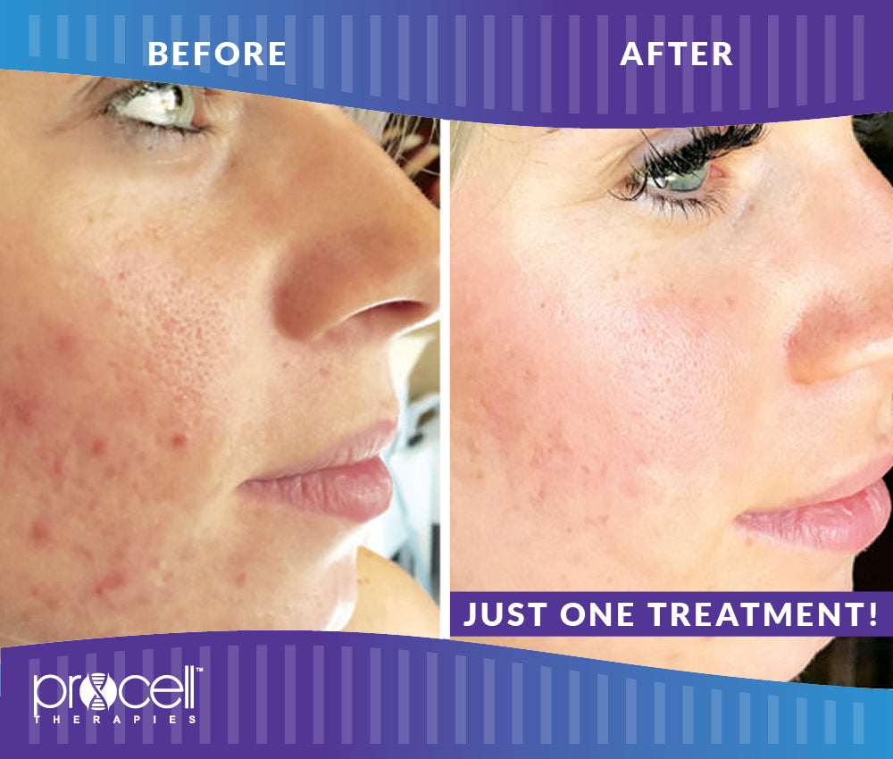 Free Consultation on ProCell Facial Microchanneling